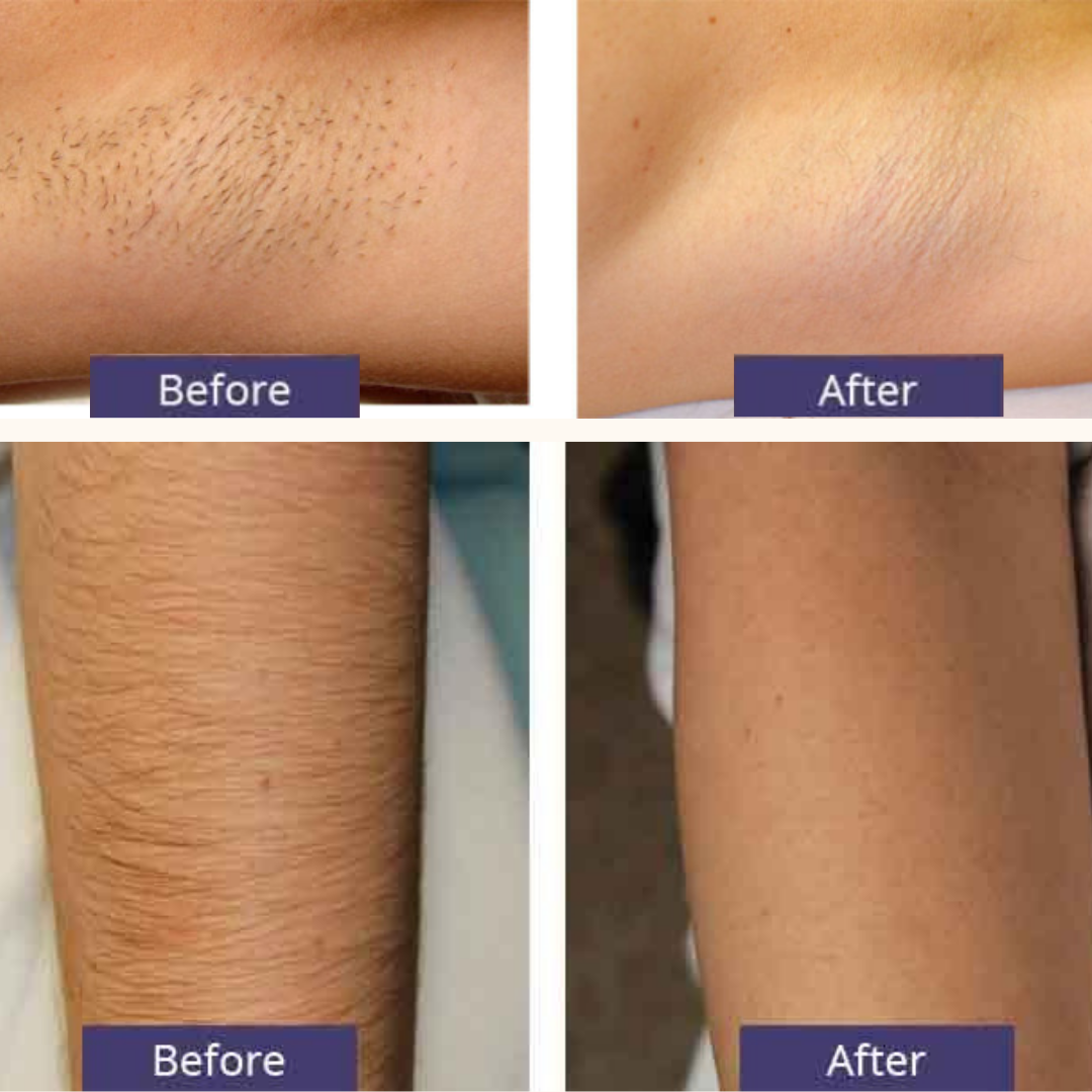 PureGlow™ Pro Laser - Dermatologisch Geteste Ontharingslaser