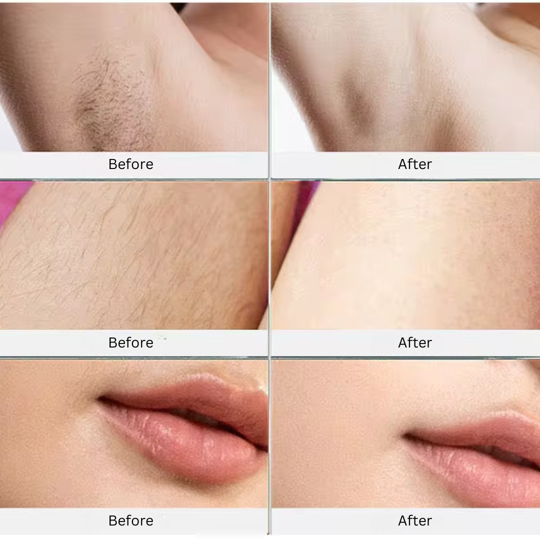 PureGlow™ Pro Laser - Dermatologisch Geteste Ontharingslaser